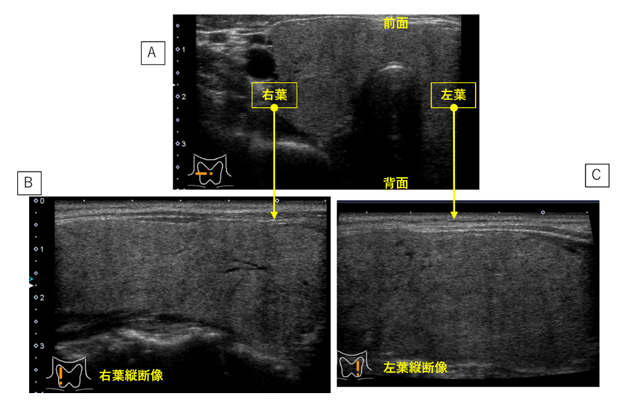 図2.バセドウ病の甲状腺エコー図
A:横断像 B:右葉縦断像 C:左葉縦断像
甲状腺右葉、左葉とも、正常よりも全体に腫大している(びまん性甲状腺腫)